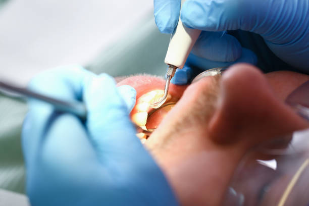 Best Emergency Root Canal Treatment in Tuckerton, NJ