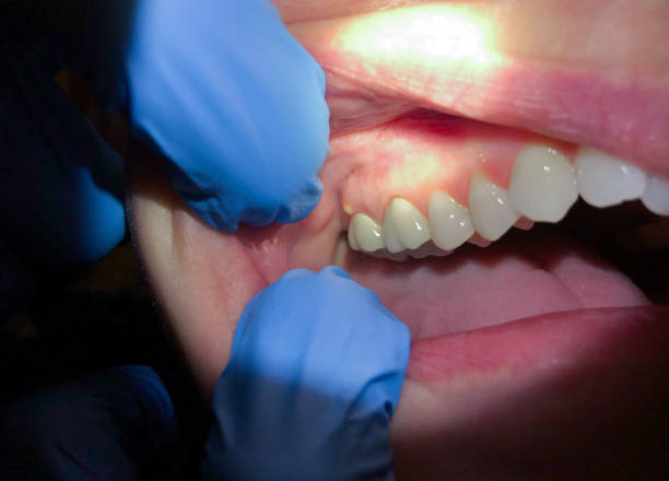 Best Urgent Care for Lost Fillings or Crowns in Tuckerton, NJ